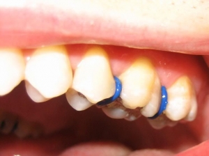 ارتودنسی چگونه دندانها را صاف میکند