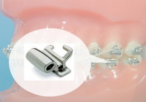 ارتودنسی چگونه دندانها را صاف میکند