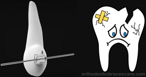لق شدن دندان در ارتودنسی