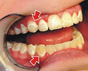 لکه های روی دندان ناشی از بریس ارتودنسی