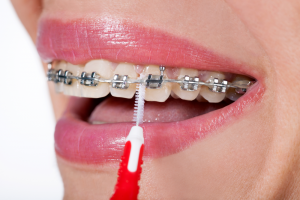 لکه های روی دندان ناشی از بریس ارتودنسی