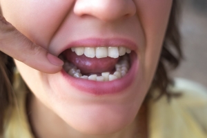 درمان شلوغی دندان با اینویزیلاین 