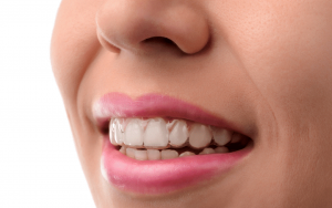 درمان شلوغی دندان با اینویزیلاین 
