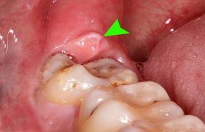 تأثیر دندان عقل بر ارتودنسی دندان