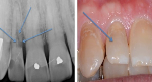 تاثیر ارتودنسی بر تحلیل ریشه دندان