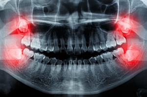 تأثیر دندان عقل بر ارتودنسی دندان