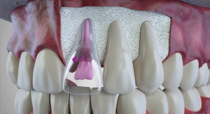 تاثیر ارتودنسی بر تحلیل ریشه دندان