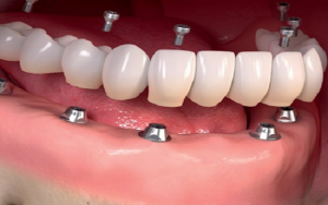  ارتودنسی دندان ایمپلنت شده